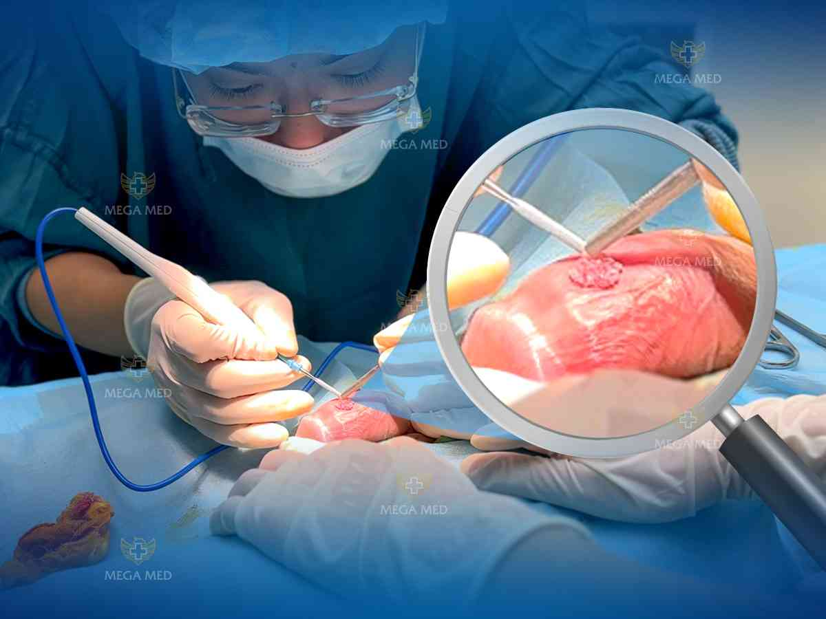 Hình ảnh trị sùi mào gà bằng phương pháp cắt đốt bằng sóng cao tần